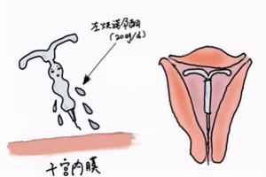 鸡西痛经上环可以缓解吗(痛经上环后不来月经正常吗)