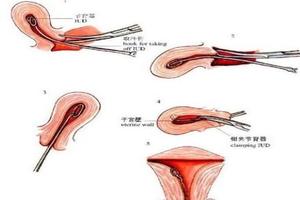 鸡西白带3度可以取环吗(鸡西药流价位)